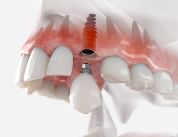 single dental implant preston